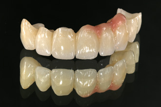 prothèses dentaires sans métal
